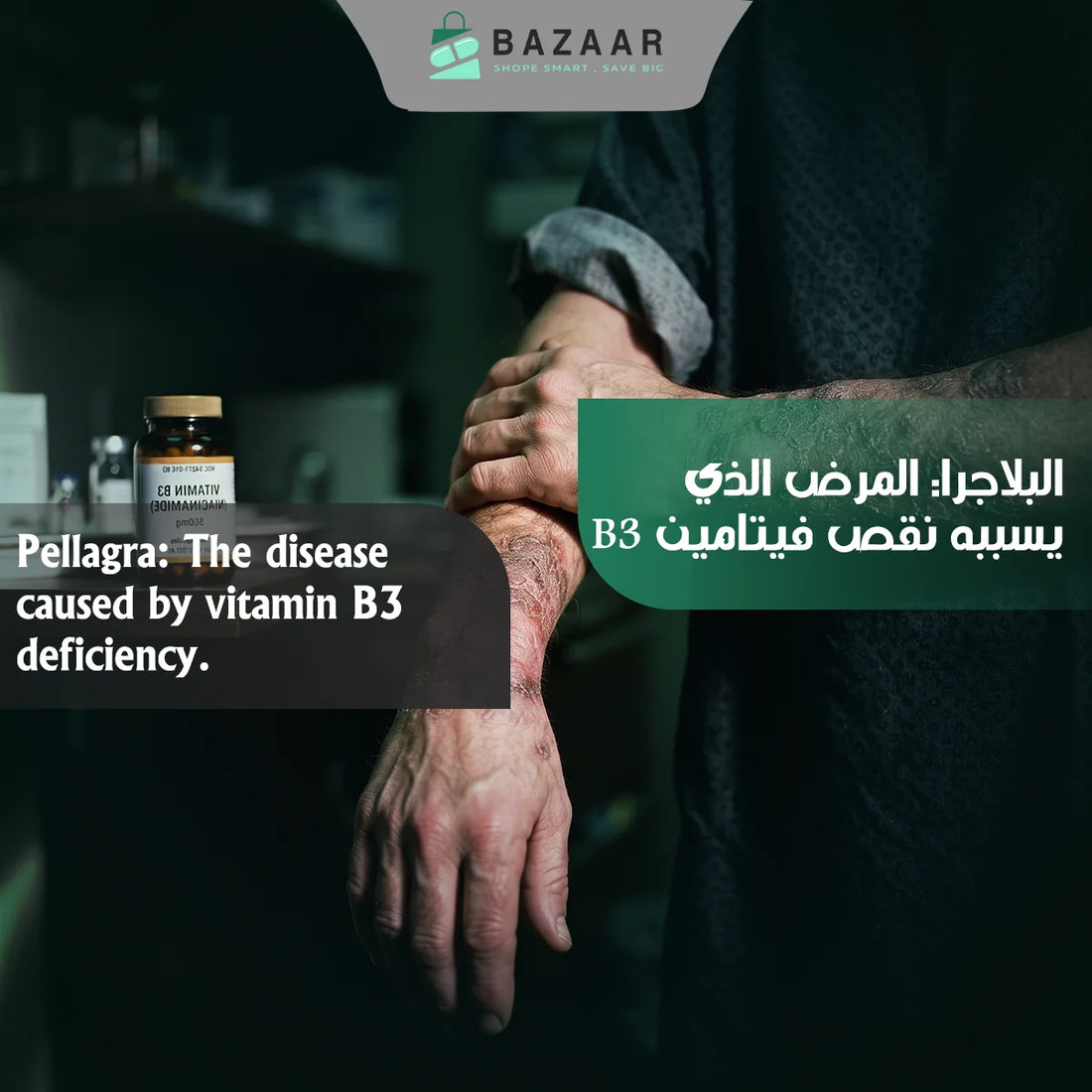 Pellagra: The Disease Caused by Vitamin B3 Deficiency